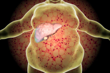 Dislipidemia in diabetico 